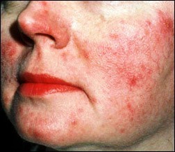 rosacea bumps