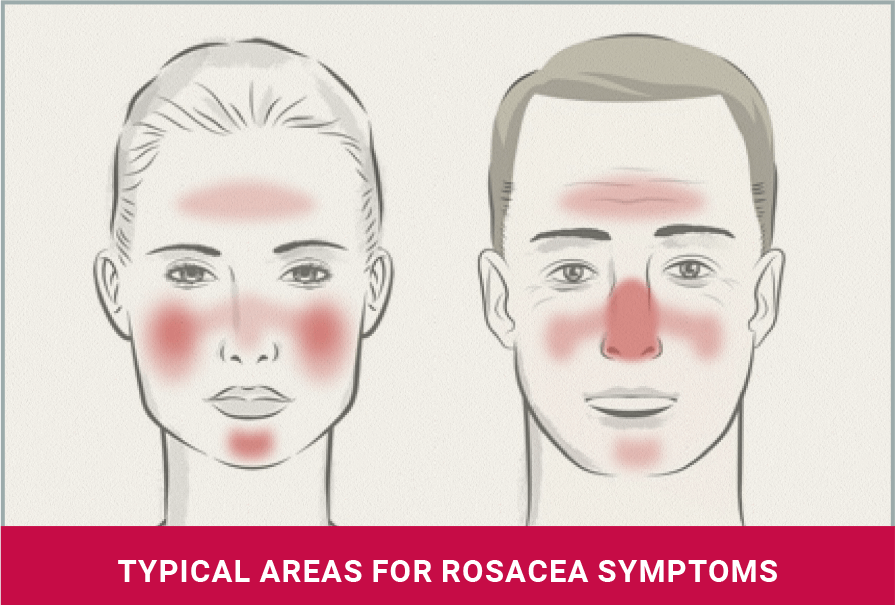 typical areas for rosacea symptoms