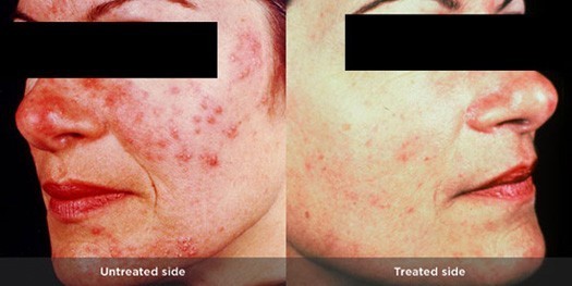 Rosacea - Huidarts.com