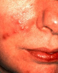 Corticosteroids cause acne
