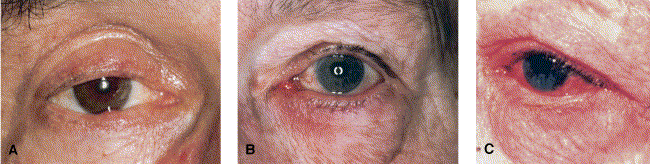 Subtype 4: ocular rosacea