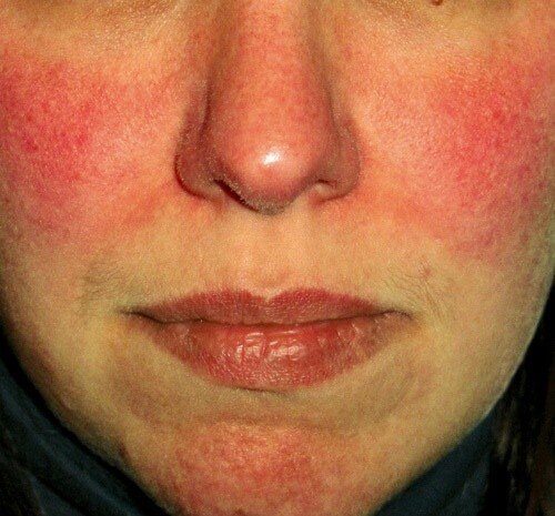 Survey Shows Facial Redness Takes Emotional Toll | Rosacea.org