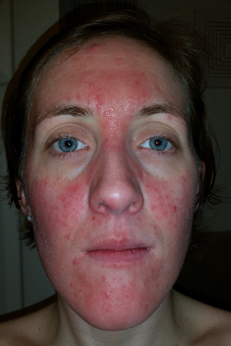 rosacea patient experiencing a flare-up