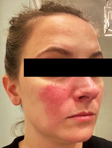 woman with facial erythema from rosacea