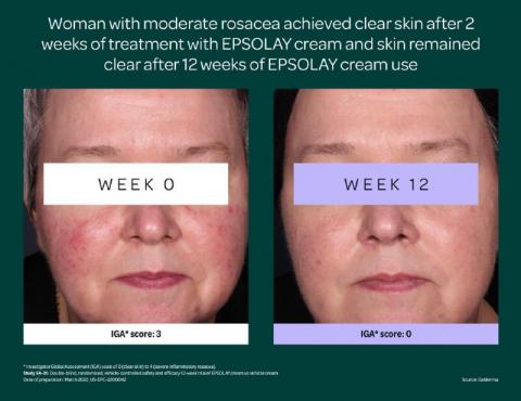 EPSOLAY patient before/after
