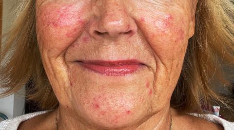 elderly rosacea patient