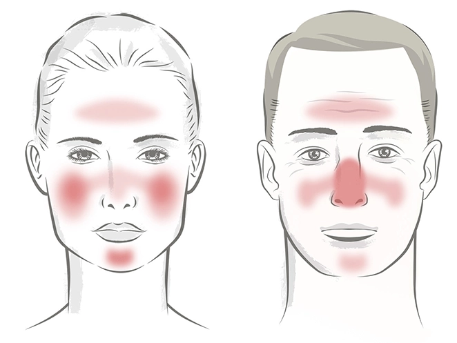 National Rosacea Society | Rosacea.org