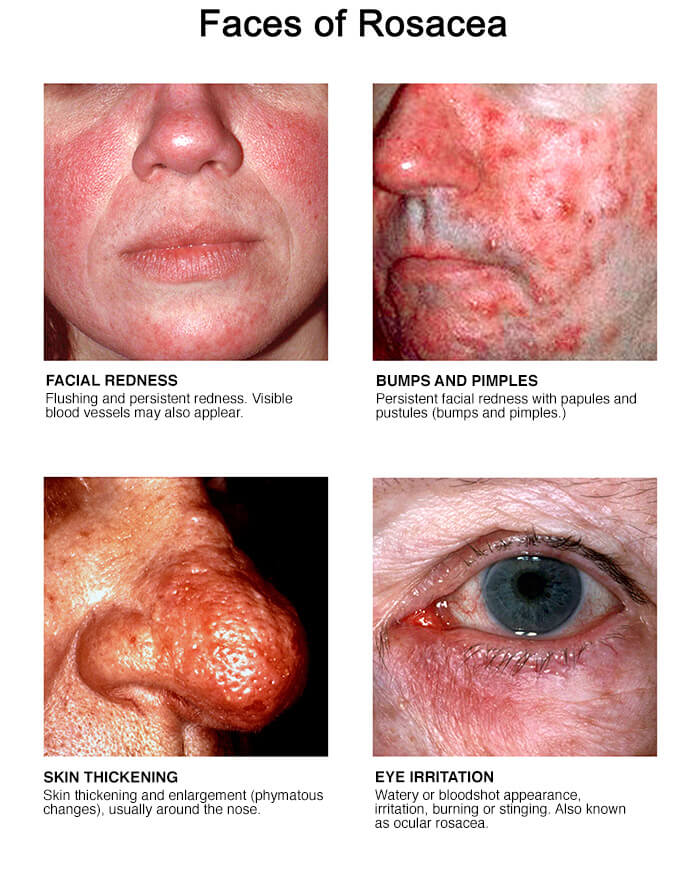 Faces of Rosacea photo