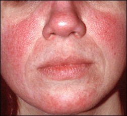 Medical Therapy for Rosacea  Rosacea.org