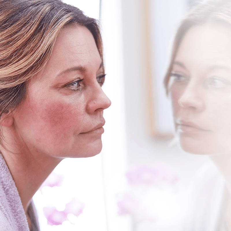 New York Rosacea Treatment