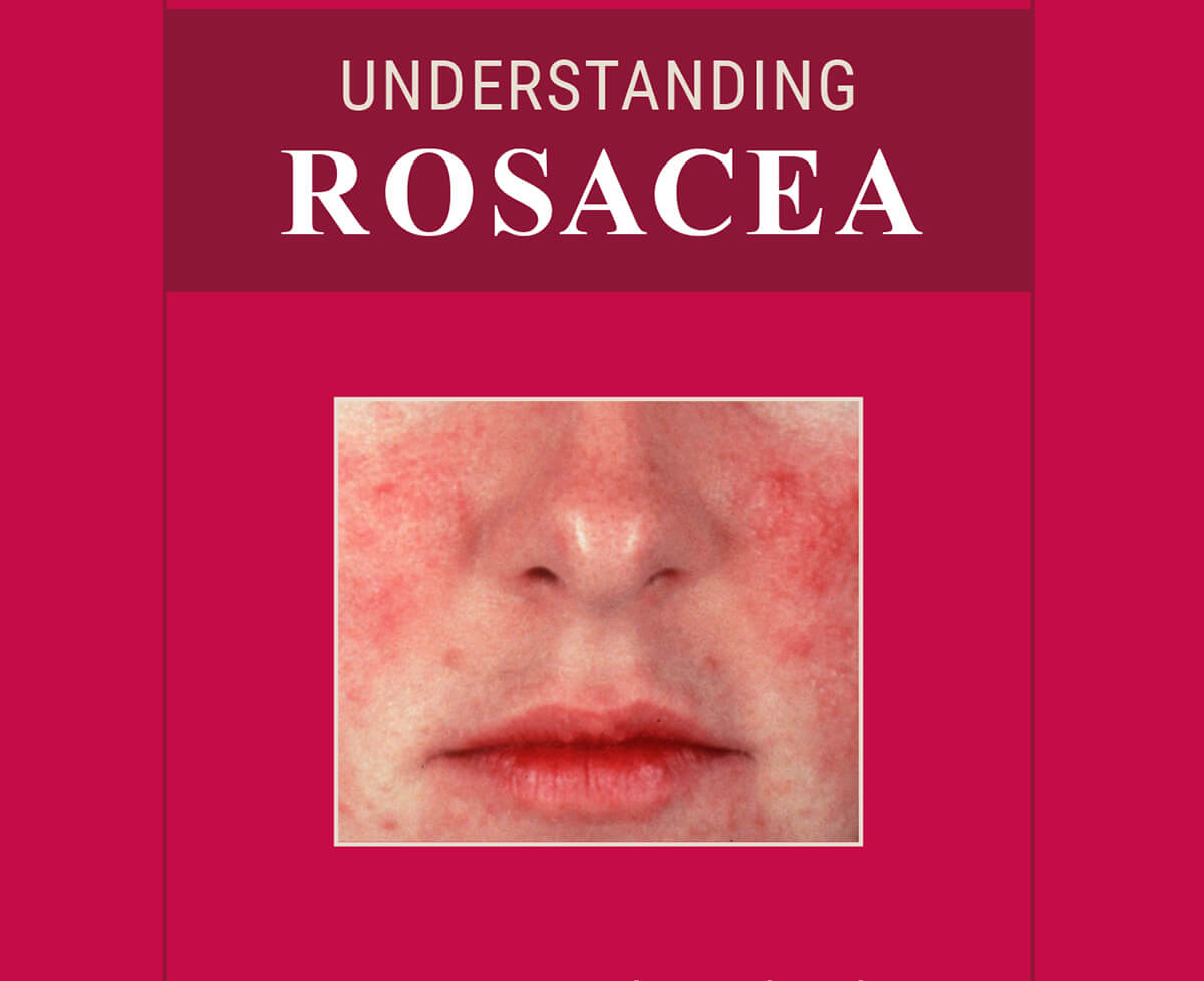 Understanding Rosacea booklet