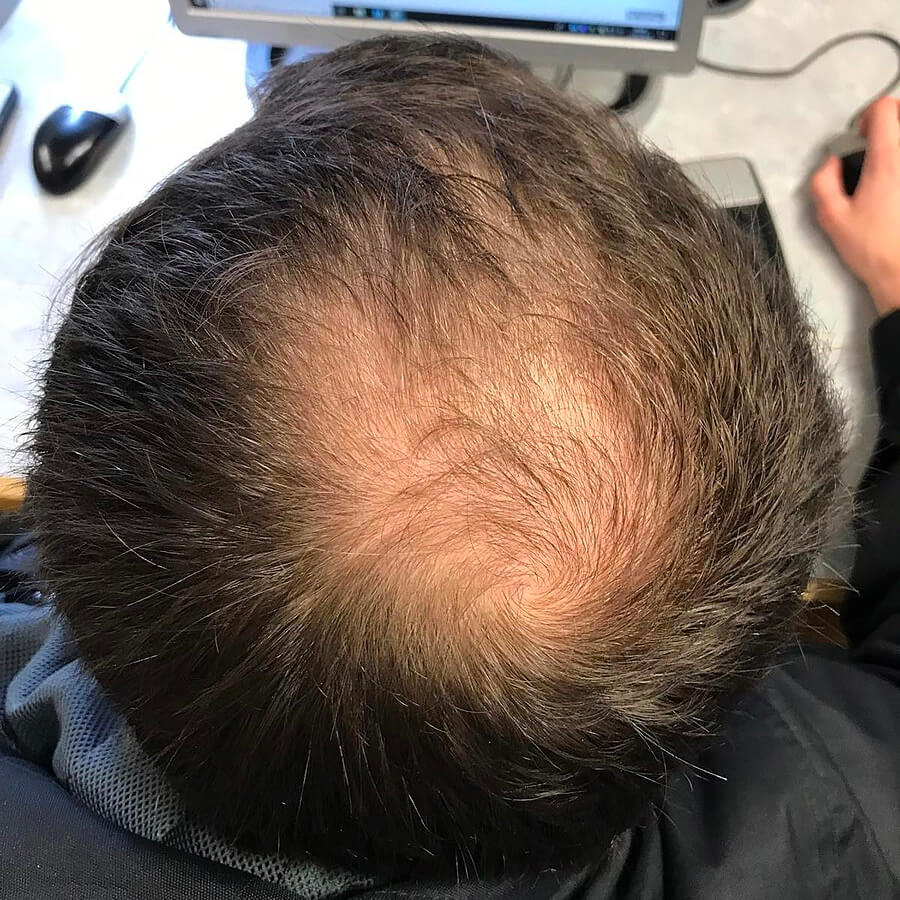 androgenetic alopecia