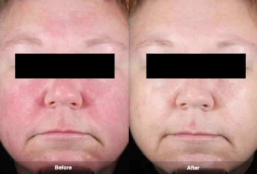 Rosacea Treatment Photos