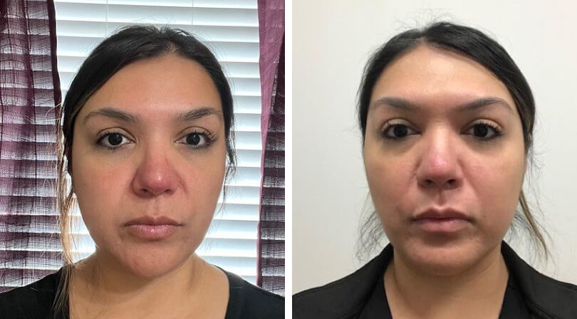 Daniella before and after EPSOLAY treatment