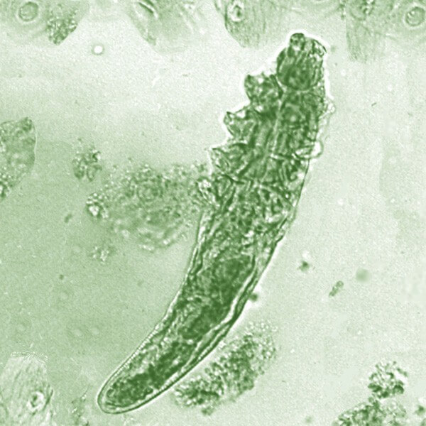 Demodex folliculorum mites