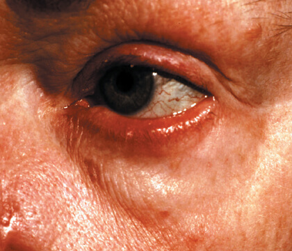 Understanding Rosacea: eye irritation (ocular rosacea)