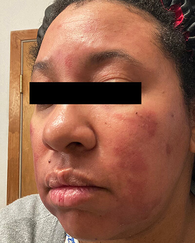 rosacea patient of color