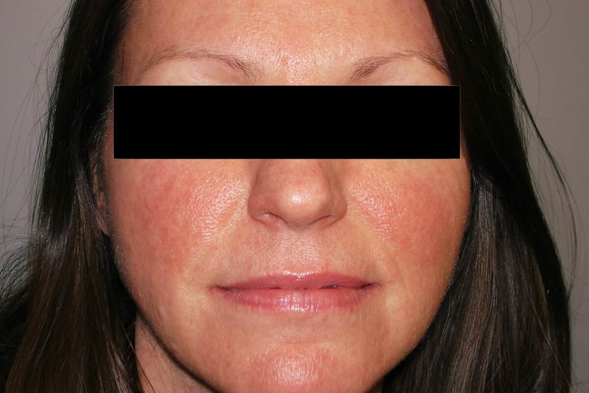 rosacea patient photo