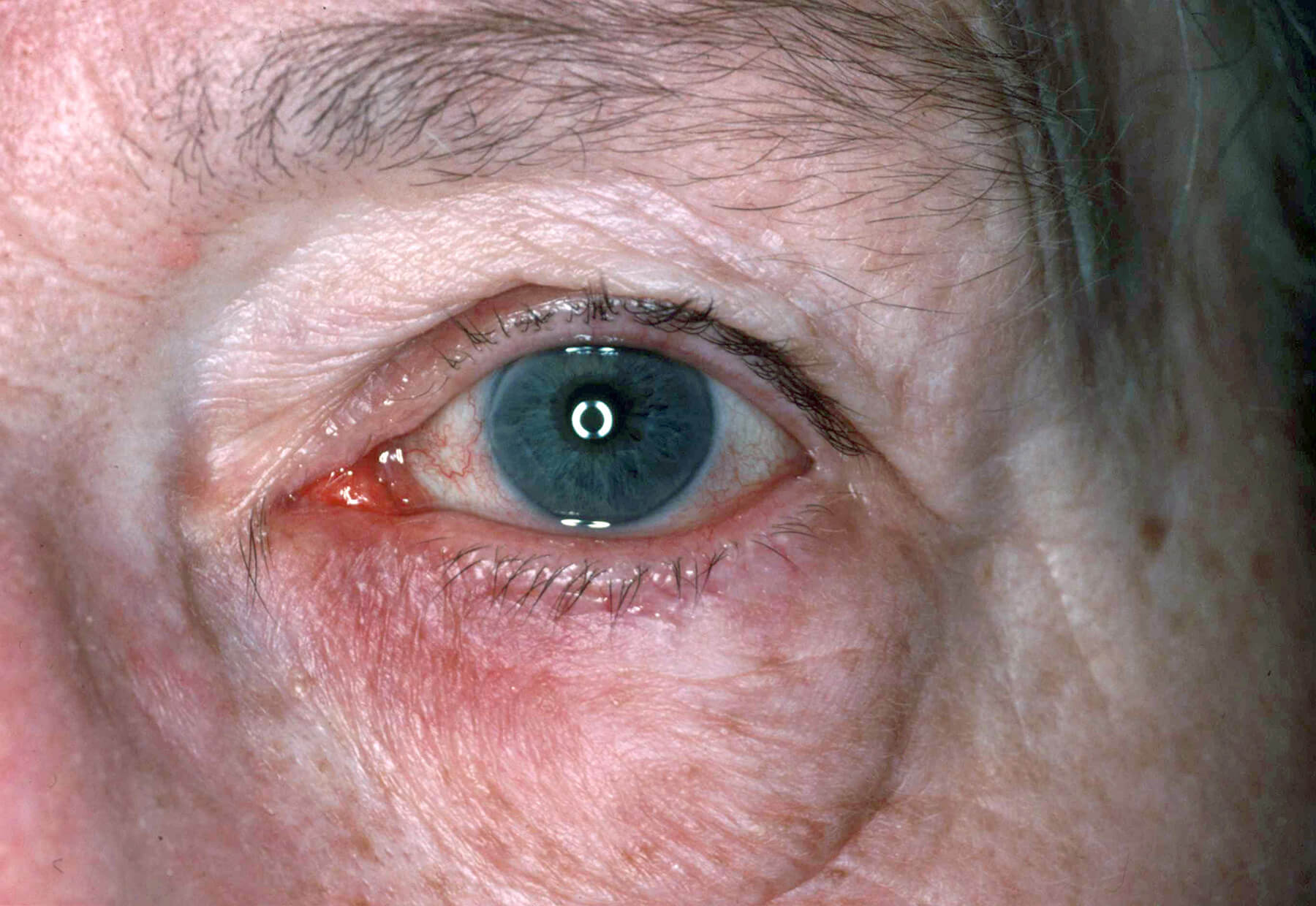 ocular rosacea