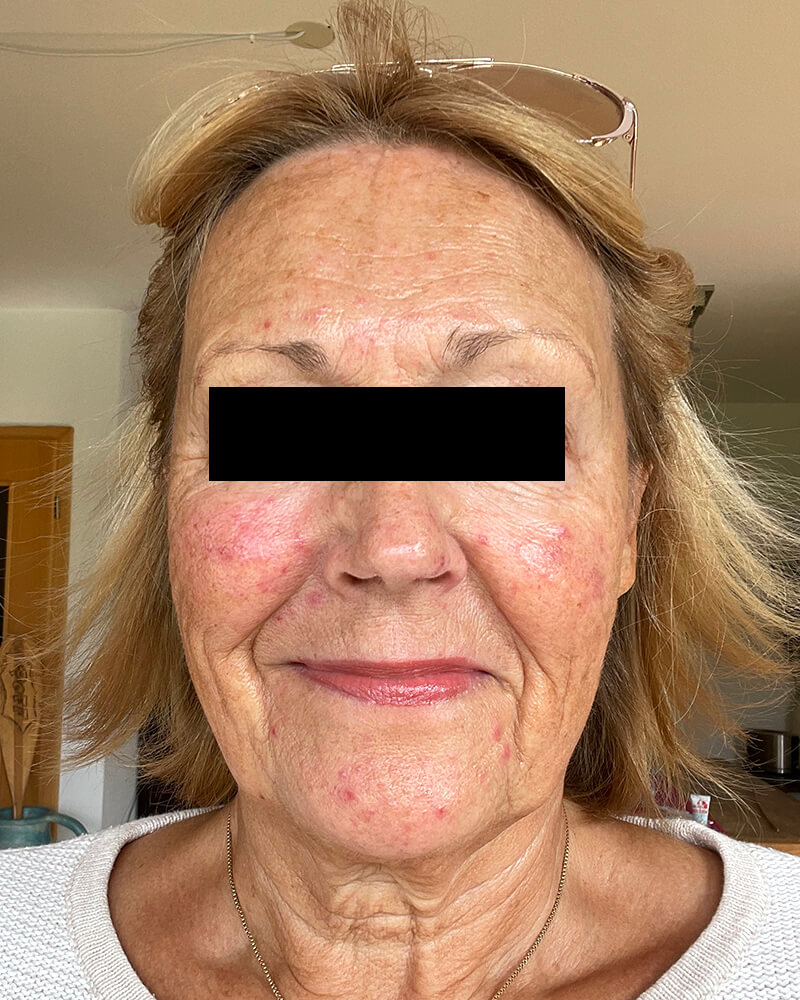 female rosacea patient