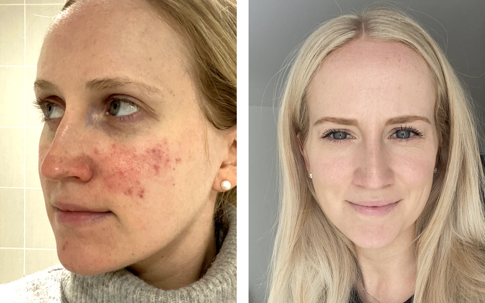 rosacea patient before and after photos