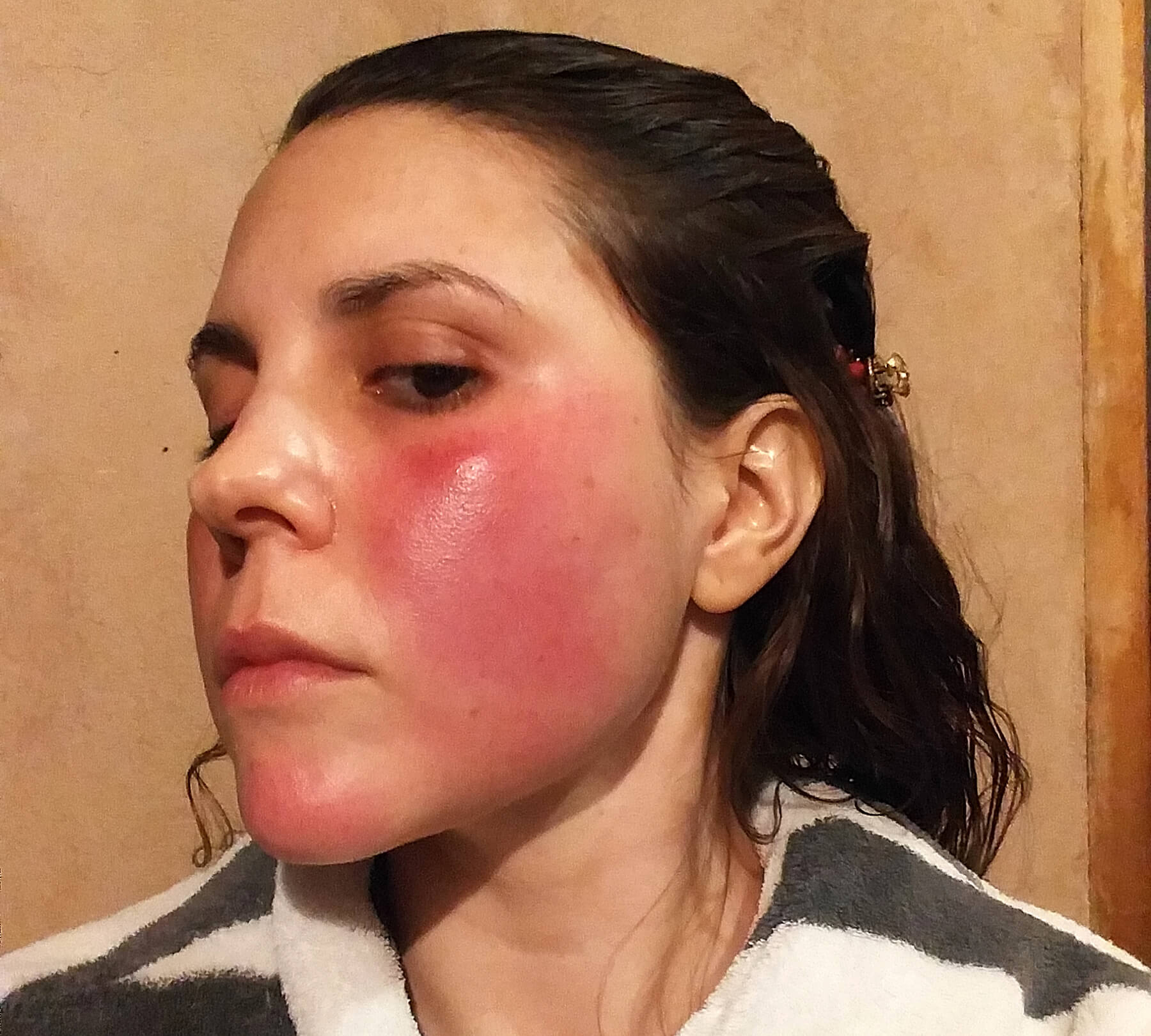 rosacea facial erythema