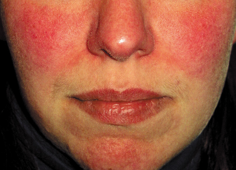 New Updates Physicians on Redness in Rosacea | Rosacea .org