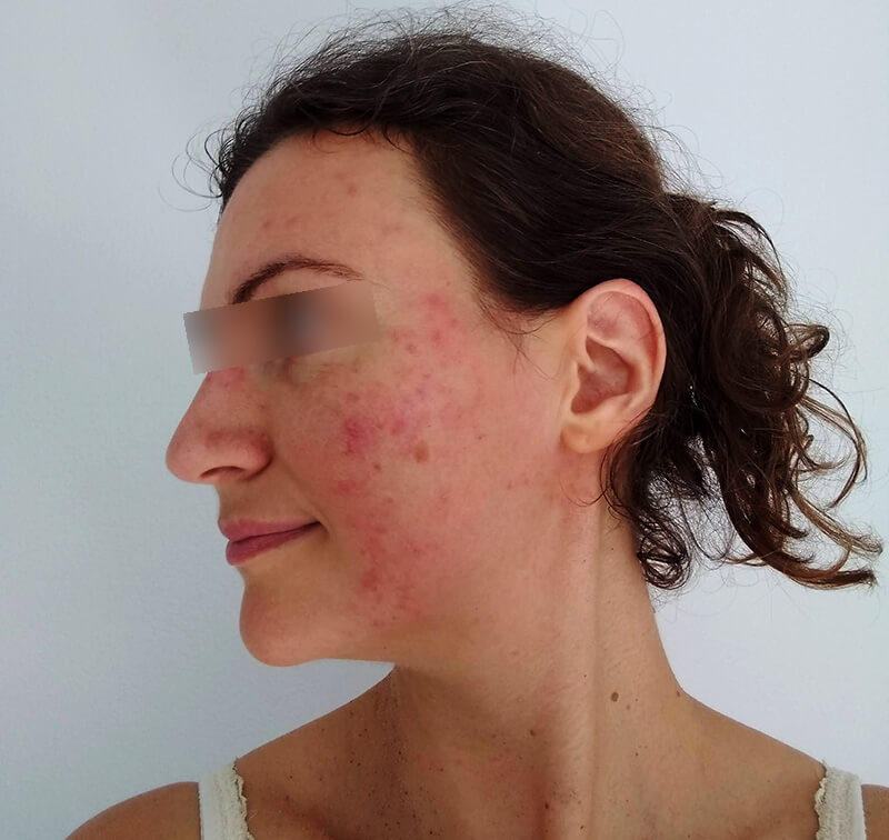 rosacea patient with bumps and pimples