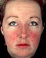 face with rosacea