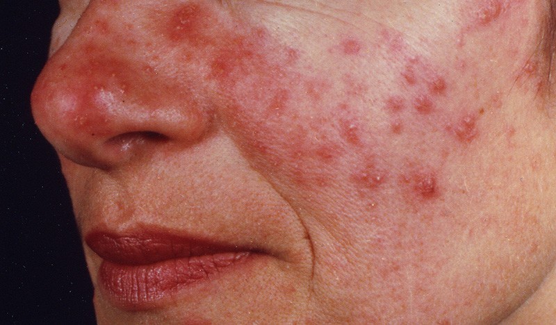 subtype 2 rosacea