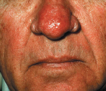 Understanding Rosacea: skin thickening