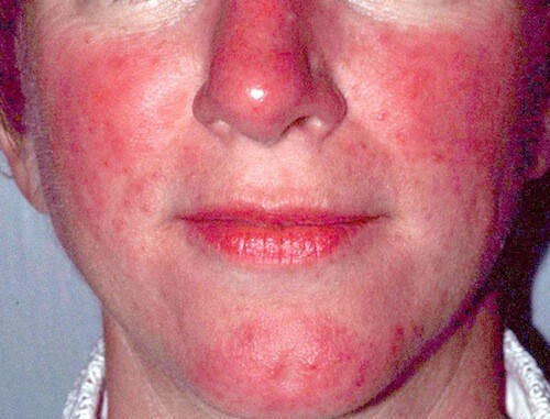 Rosacea Picture Image on MedicineNet.com