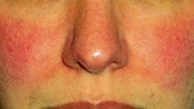 subtype 1 rosacea