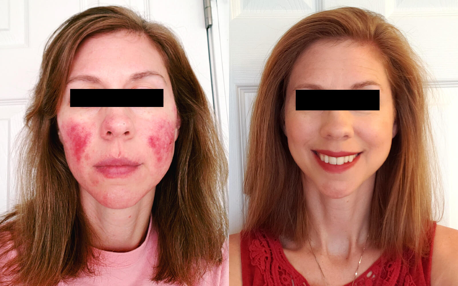 rosacea before and after treatment