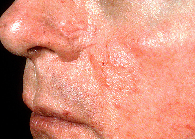 rosacea patient with telangiectasia