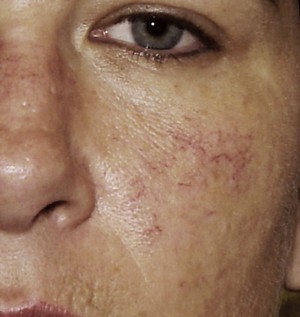 Steroid induced acne rosacea