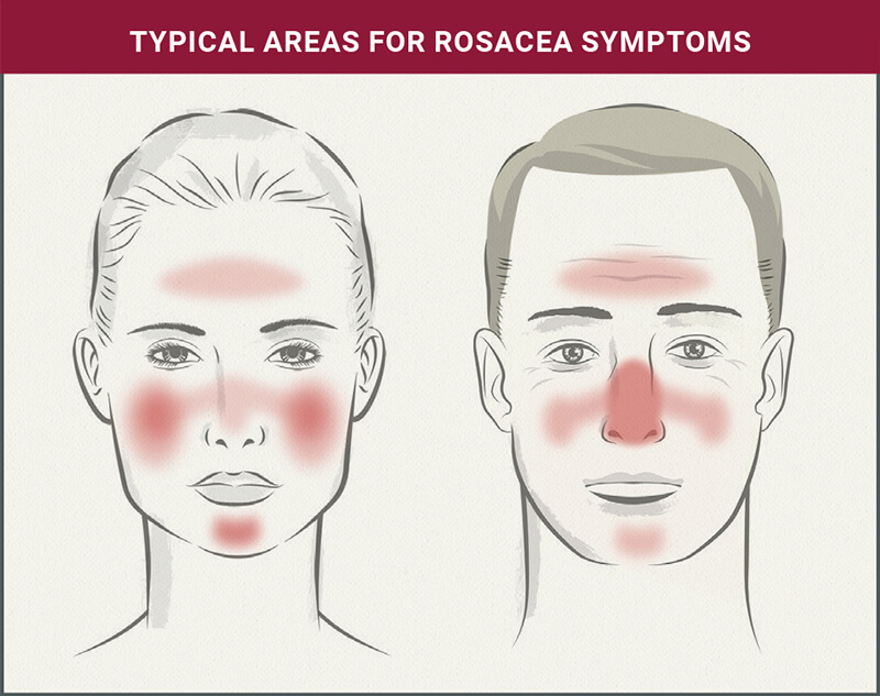 Understanding Rosacea: Typical Areas for Rosacea Symptoms