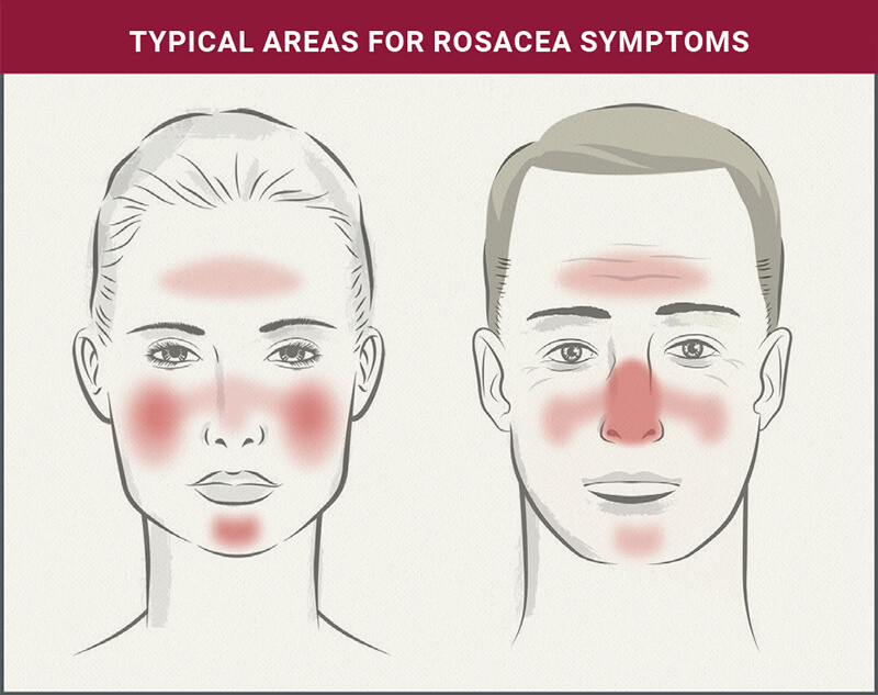 Understanding Rosacea