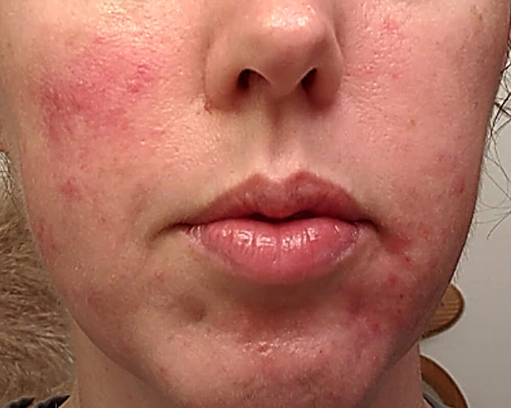 rosacea patient with erythema and dryness