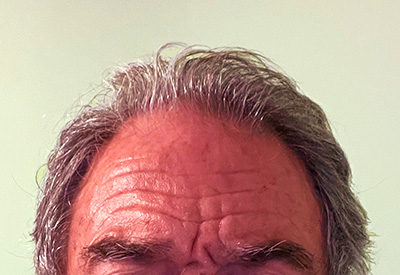 man with receding hairline