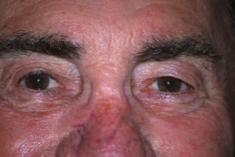 man with ocular rosacea