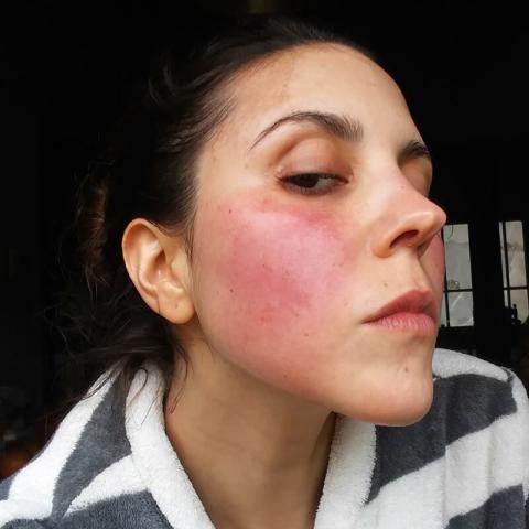 patient with persistent redness from rosacea