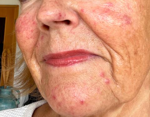 female rosacea patient
