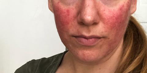 acne and rosacea
