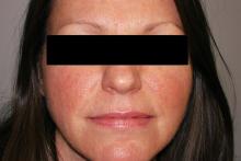 facial erythema