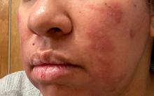 rosacea patient of color