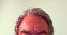 man with receding hairline